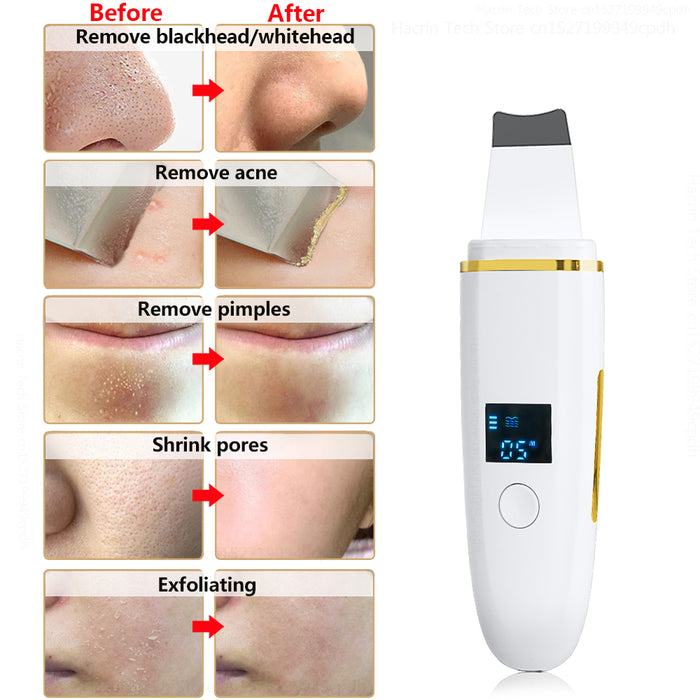 Scrubber Ultrasonique Z9: Nettoyage Profond, Lifting & Anti-acné